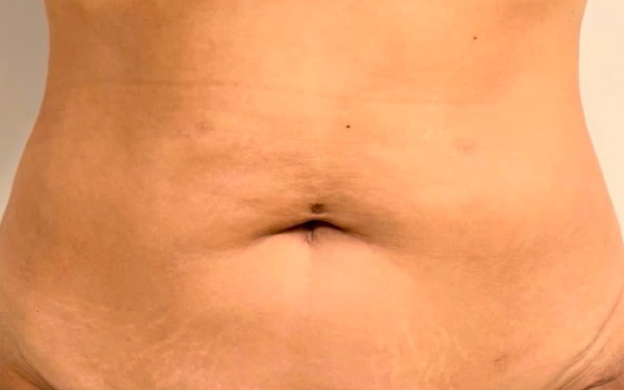 Abdominoplastie — Après