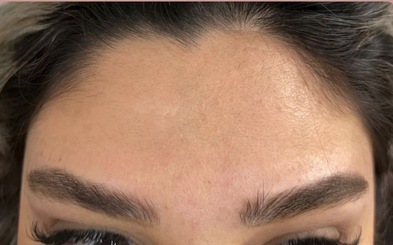 Botox — Après