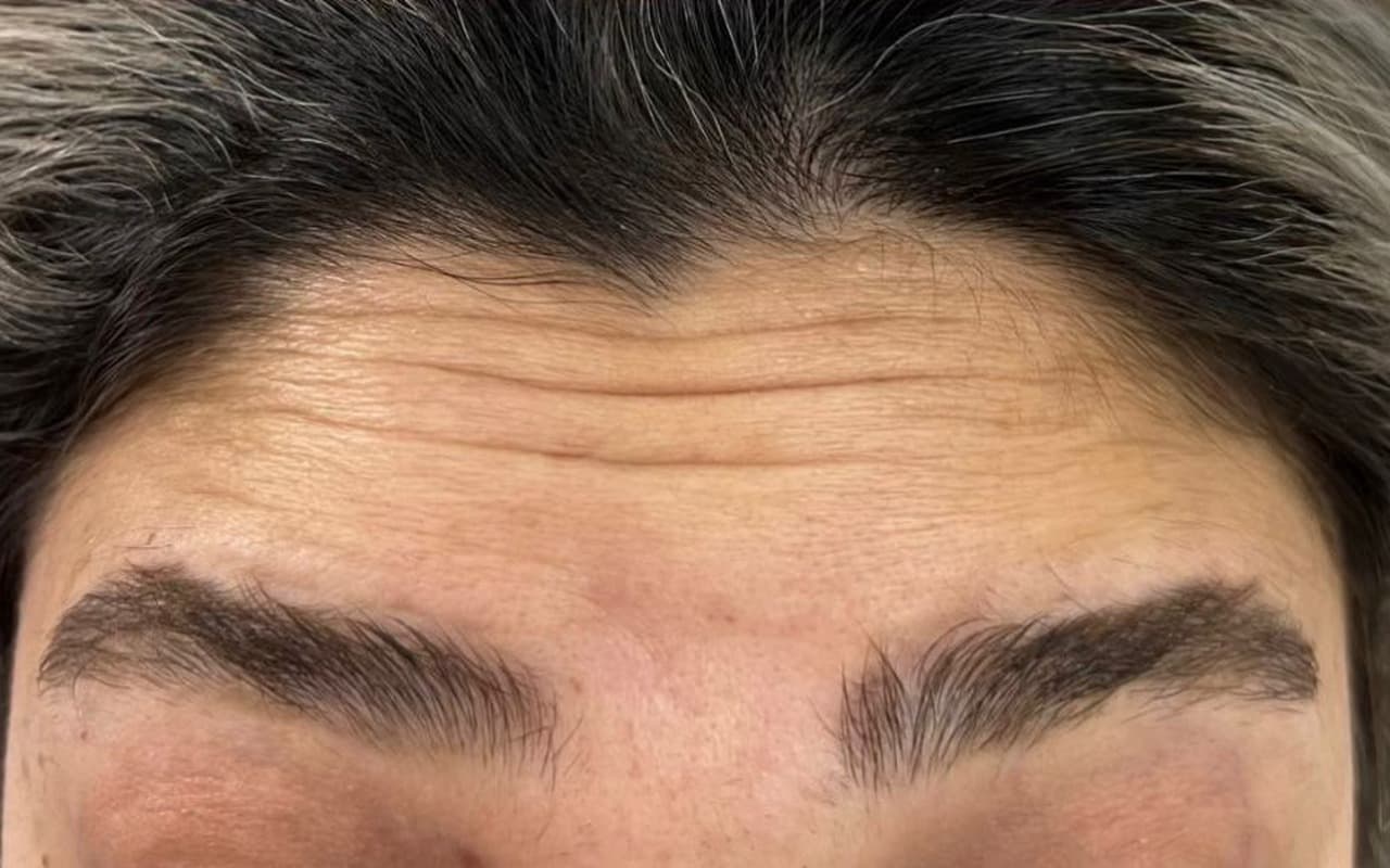 Botox — Avant