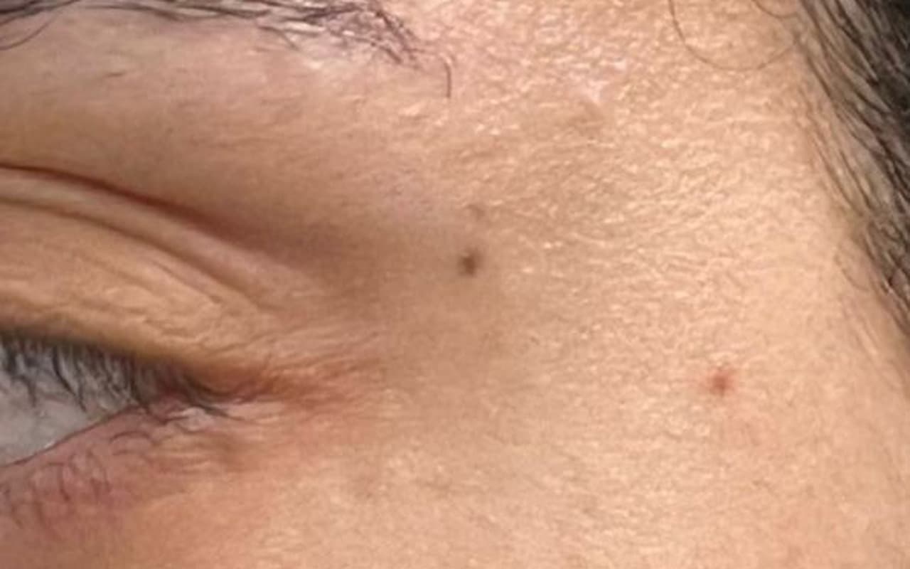 Botox — Pattes d'oie — Après