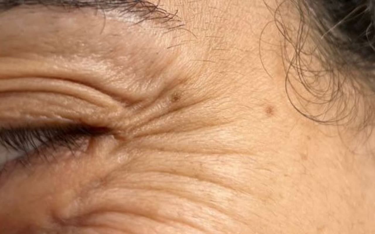 Botox — Pattes d'oie — Avant