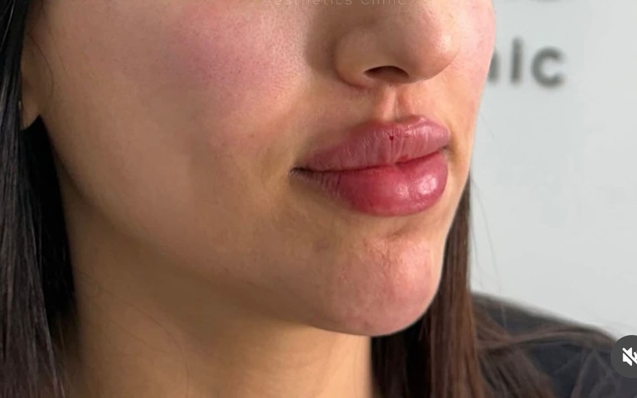 Fillers — Lèvres — Après