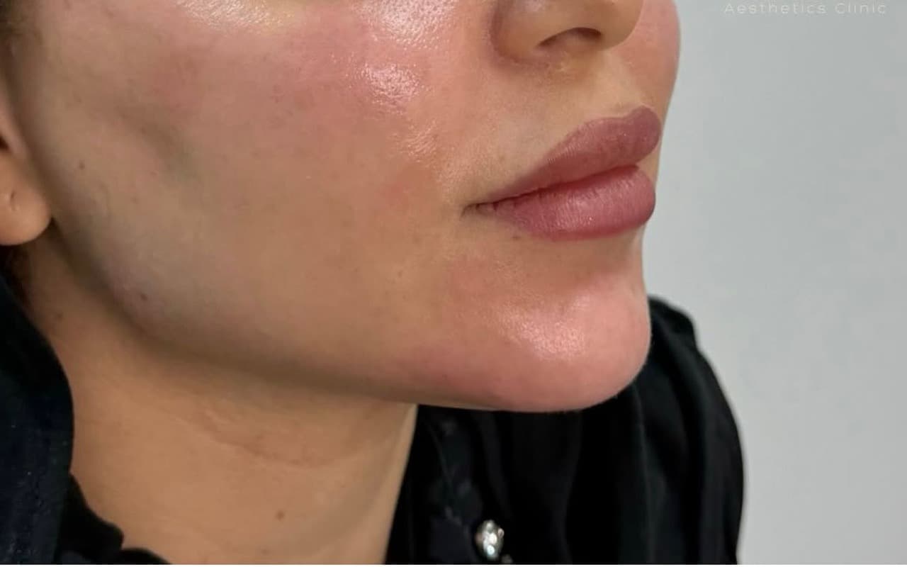 Fillers — Menton & Mâchoire — Après