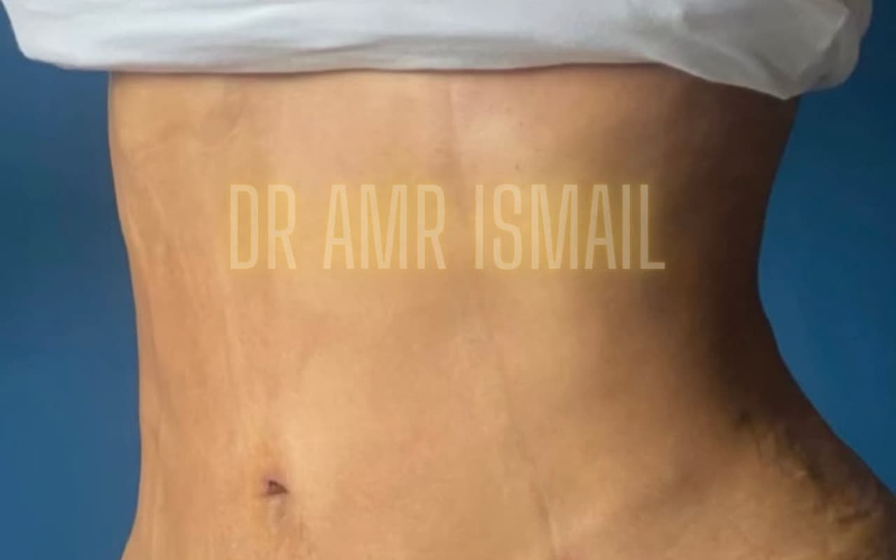 Liposuccion & Lipo 4D — Après
