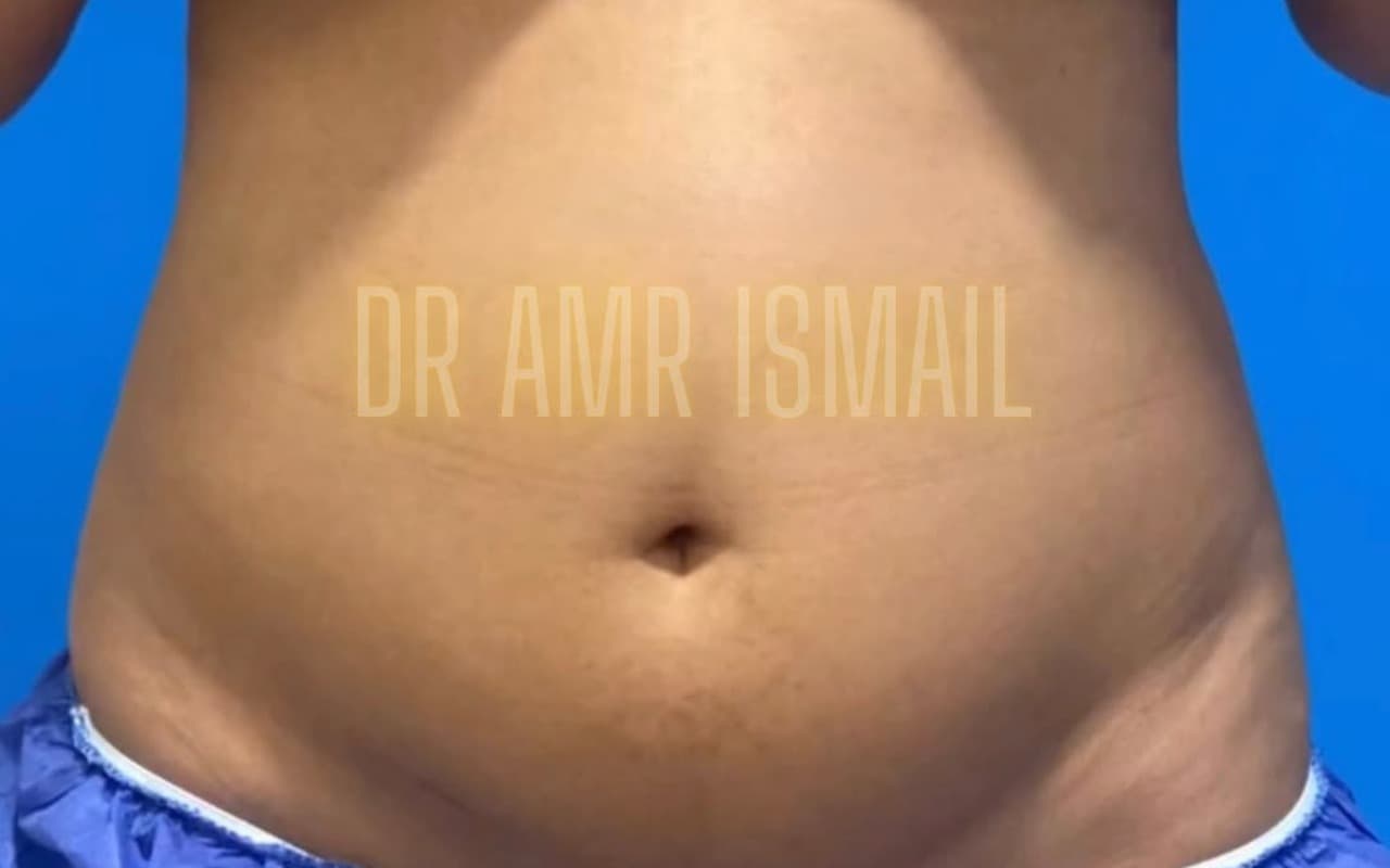 Liposuccion & Lipo 4D — Avant