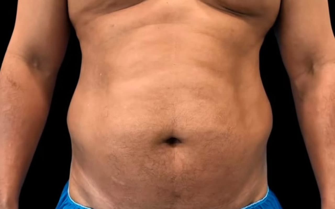 Liposuccion & Lipo 4D — Avant