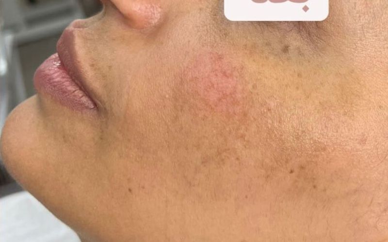 Après — Peeling Chimique